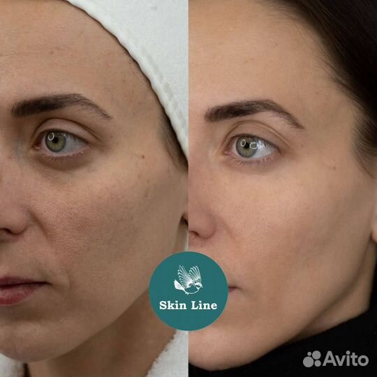 Микротоки / омолаживание