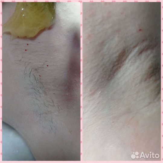 Депиляция: шугаринг/воск