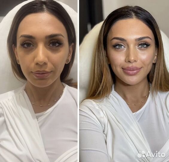 Увеличение губ модель москва