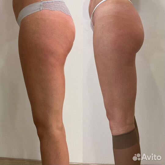 Антицеллюлитный массаж,коррекция фигуры