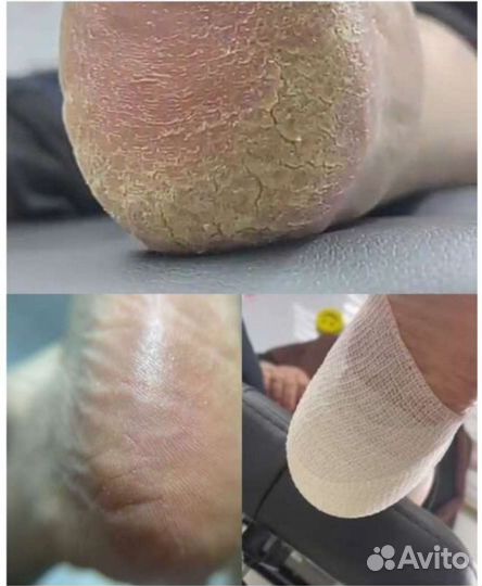 Педикюр.Подолог, установка Титановой нити