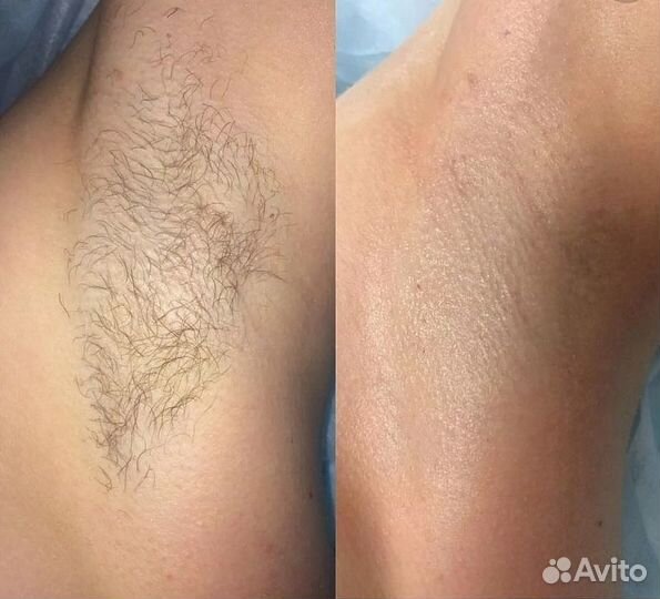 Лазерная эпиляция. Первая процедура в подарок