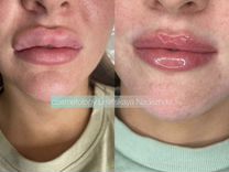 Врач косметолог: удаление увеличение губы скулы