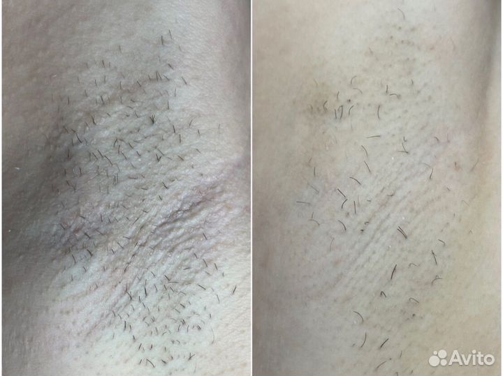 Электроэпиляция