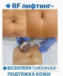 Процедура криолиполиз