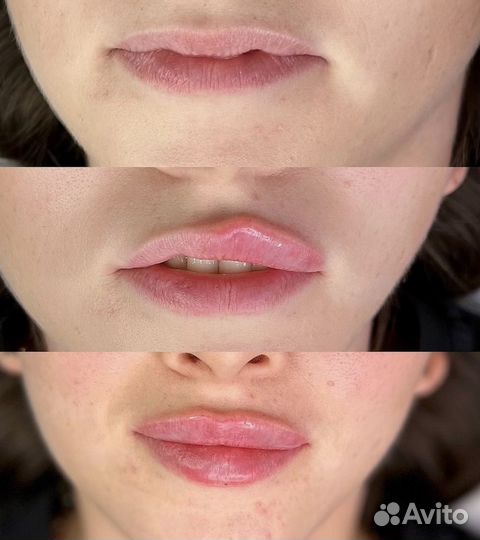 Контурная пластика, увеличение губ