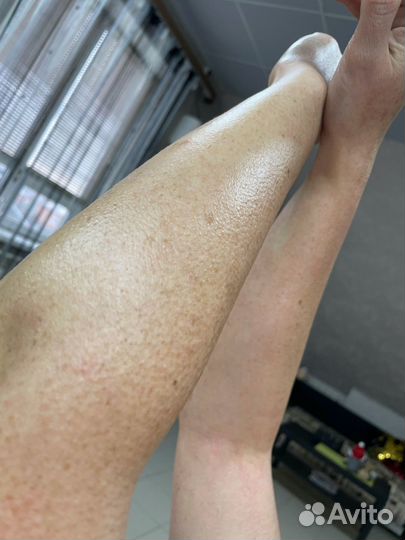 Шугаринг, депиляция, лазерная эпиляция