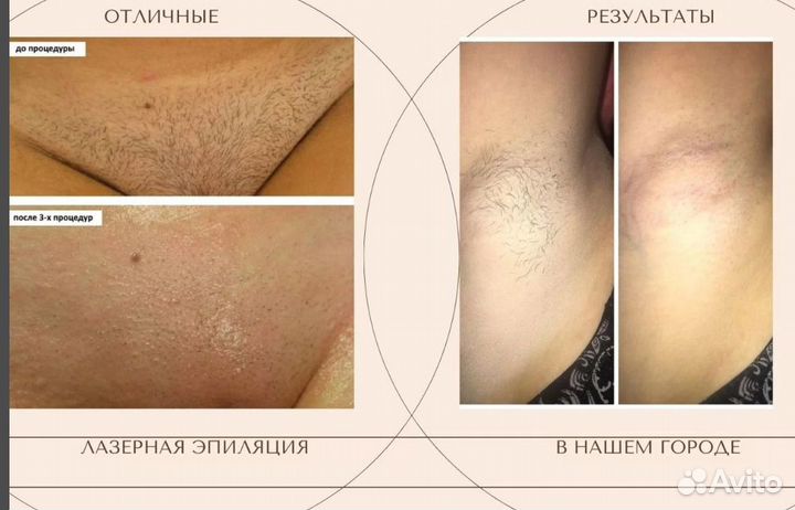 Лазерная эпиляция александритовая+диодная волна