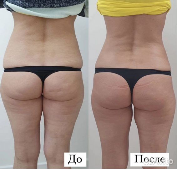 Vela shape/коррекция фигуры/rfлифтинг/кавитация