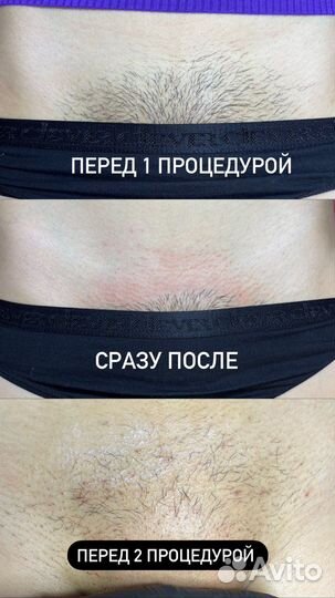 Электроэпиляция