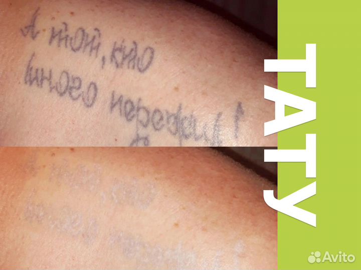 Лазерное удаление татуировок и татуажа