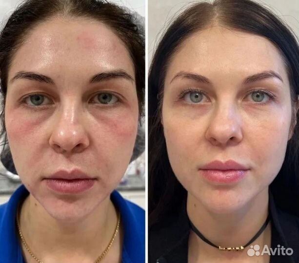 Коктейль Монако + ботокс