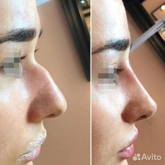 Безоперационная ринопластика
