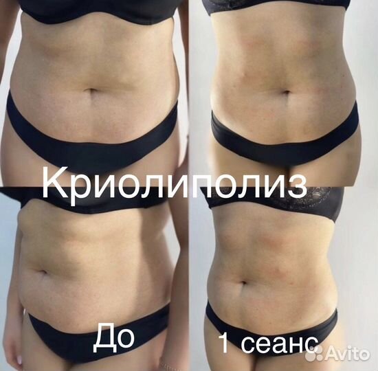 Криолиполиз New система липосакции