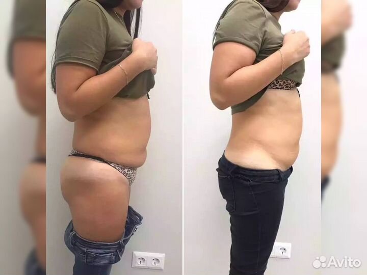 Липолитик. \ Устранение жировых отложений на теле