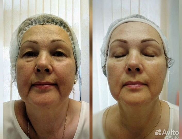 LPG массаж на оригинальном Французском аппарате