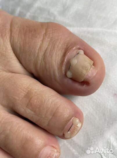 Установка коррекционной ситемы титановая нить