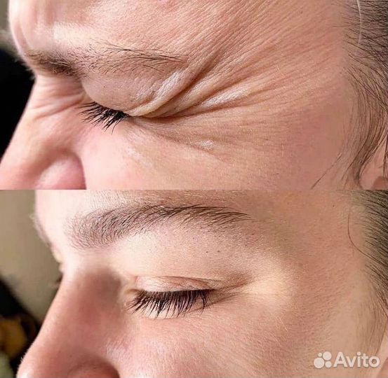 Модель на ботокс лица