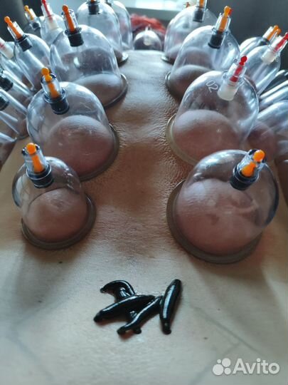 Купон на сеанс гирудотерапии