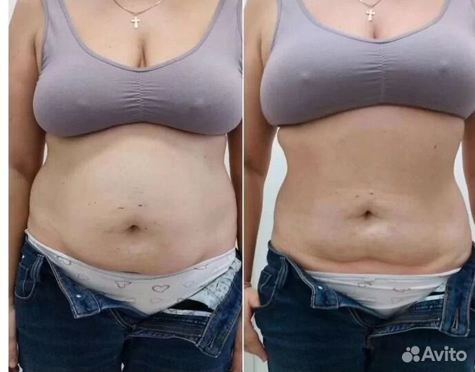 Модель на криолиполиз