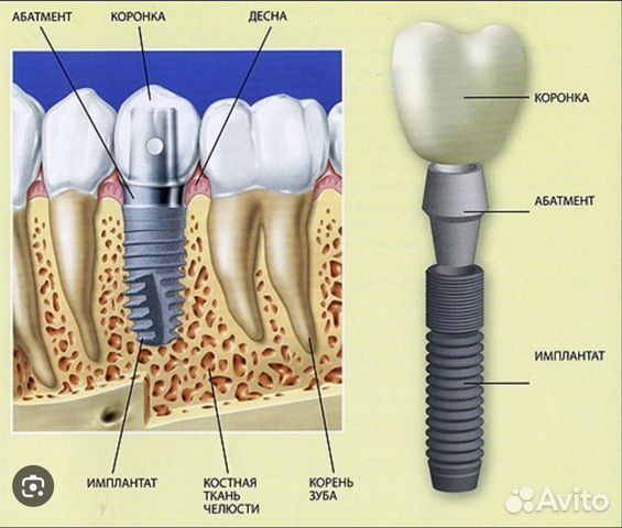 Импланты зубные объявление продам