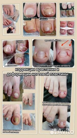 Подолог. Медицинский педикюр