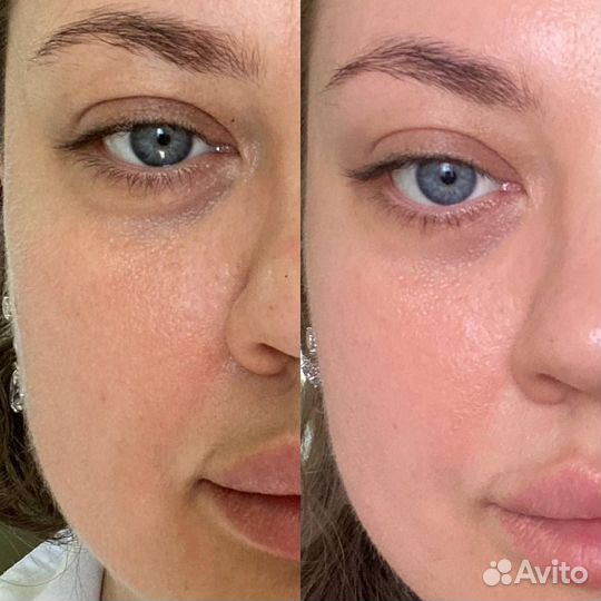 Омоложение лица FlaxSculpt