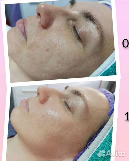 Чистка лица