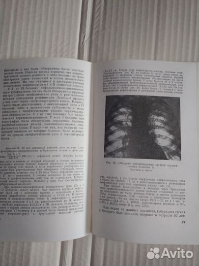 Туберкулёз легких в возрасте от 50 лет