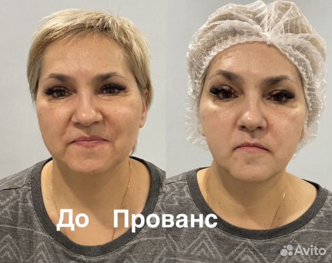 Модели на СМАС лифтинг