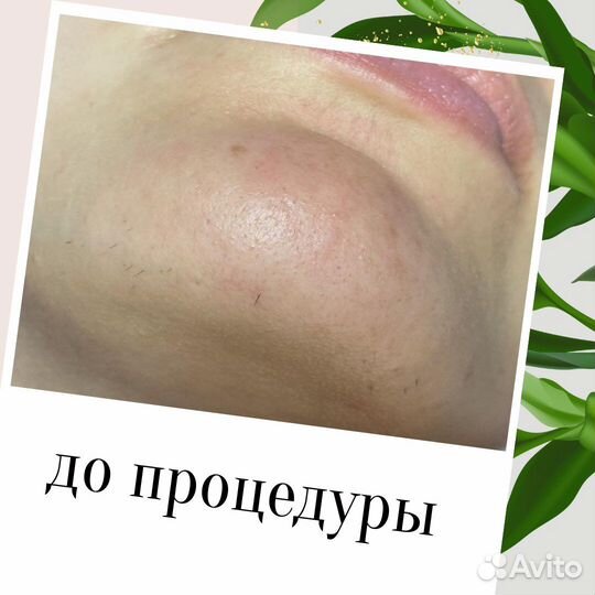 Электроэпиляция Apilus Cleo