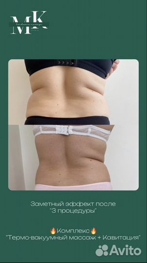 Аппаратный вакуумный массаж