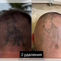 Удаление тату, татуажа, татуировок лазером, Москва