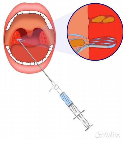 Игла для промывания лакун миндалин
