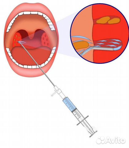 Игла для промывания лакун миндалин