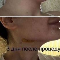 Липоредукция подбородка, Красногорск