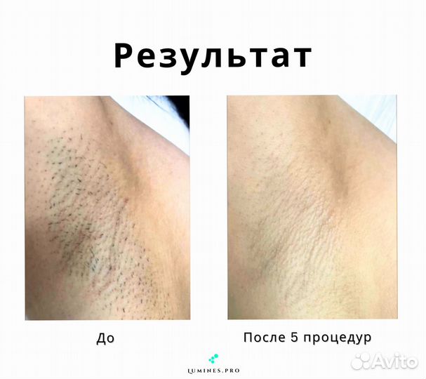 Диодный лазер люминес Макс’Ван 1200 Вт