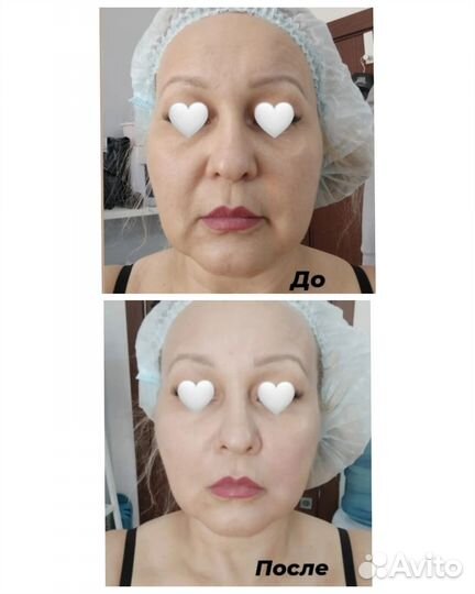 Вакуумный массаж, Кавитация, вибрационный массаж