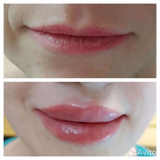 Увеличение губ косметология ботокс