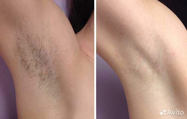 Мастер диодный эпиляции