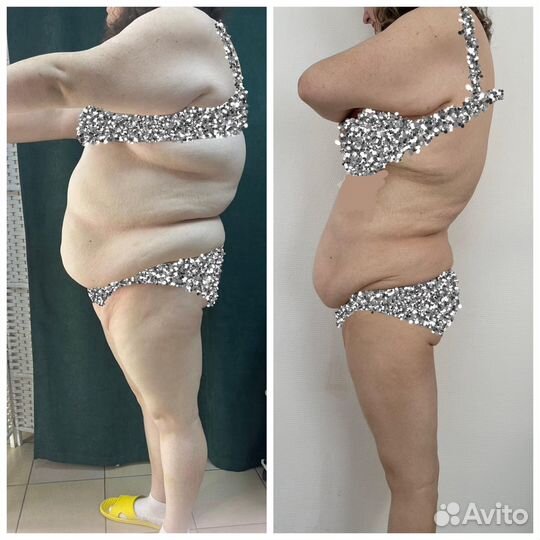 LPG массаж антицеллюлитный