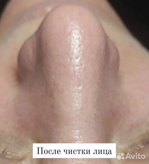 Чистка лица