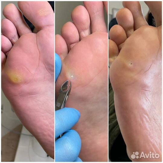 Вросшие ногти, мозоли, сухая кожа, подолог