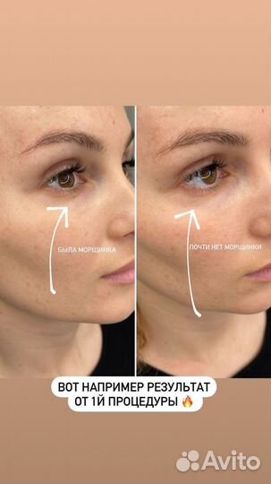 Комбинированная чистка лица