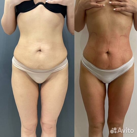 Аппаратный массаж Прессотерапия Похудение