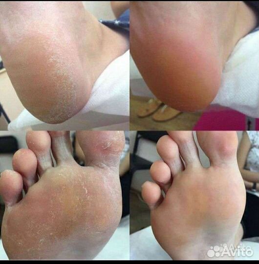 Педикюр, Подолог. Выезд на дом