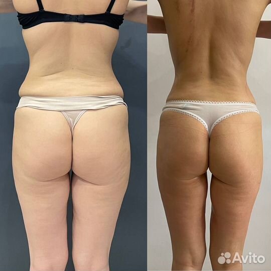 Аппаратный массаж Прессотерапия Похудение