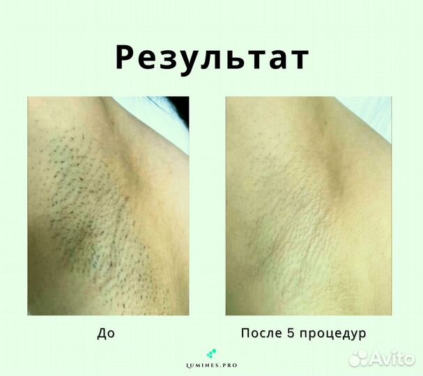 Диодный лазер Lumines’ Макс’Ван 1200вт