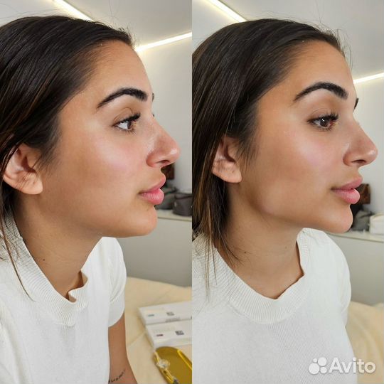 Косметолог: Ботокс, контурная пластика