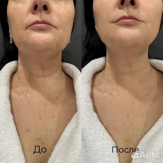 BBL Forever Young RF lifting